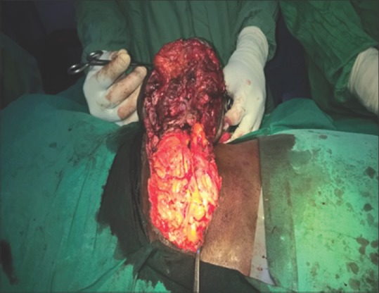 Desmoid Fibromatosis of the Lower Abdominal Wall in Irrua Nigeria.