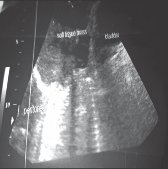 Desmoid Fibromatosis of the Lower Abdominal Wall in Irrua Nigeria.