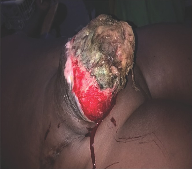 Desmoid Fibromatosis of the Lower Abdominal Wall in Irrua Nigeria.