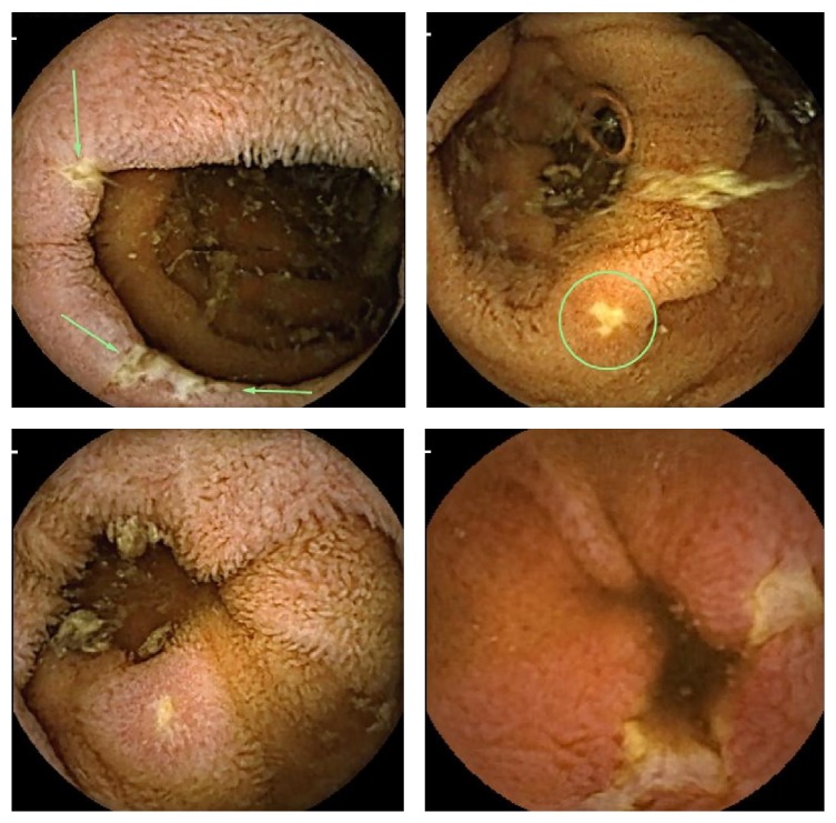 Unsuspected Small-Bowel Crohn's Disease in Elderly Patients Diagnosed by Video Capsule Endoscopy.