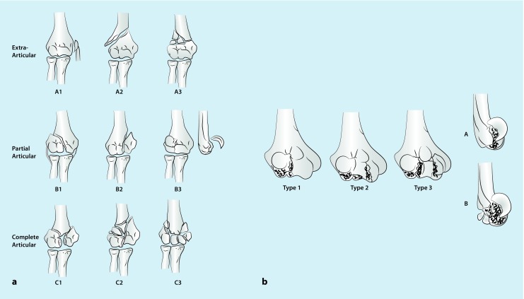 Fracture-pattern-related therapy concepts in distal humeral fractures.