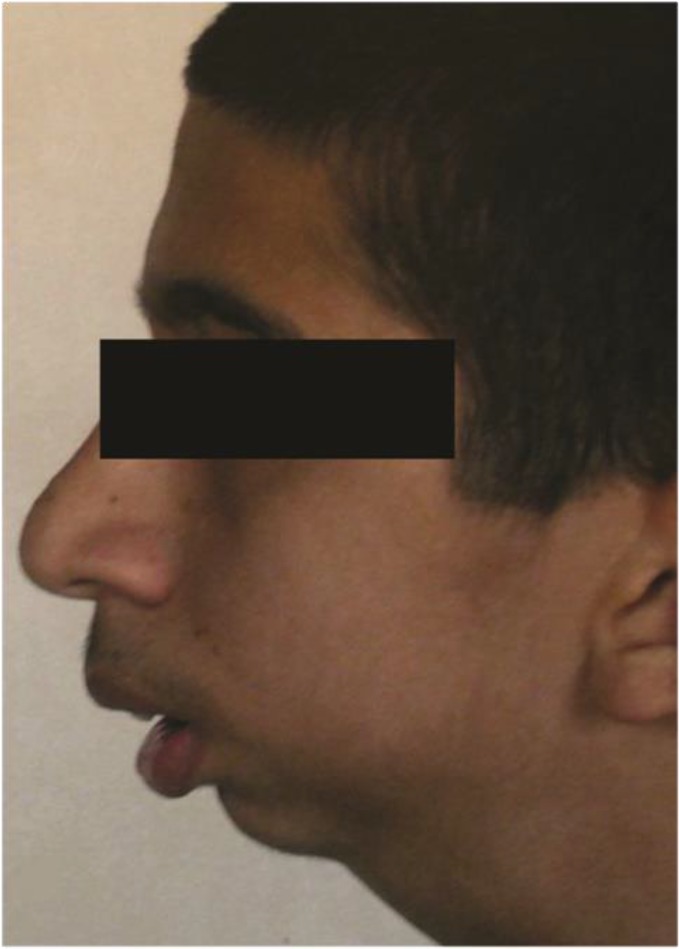 A New Method of Treatment of Temporomandibular Joint Ankylosis with Osteodistraction Using the Sh-Device: A Case Report.