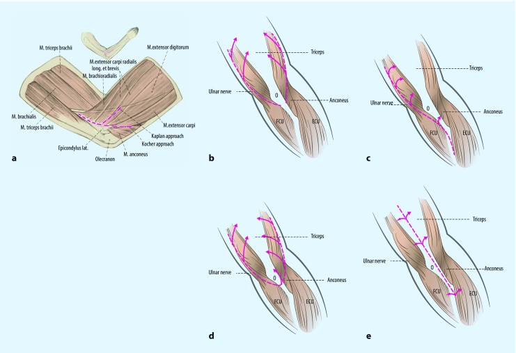 Fracture-pattern-related therapy concepts in distal humeral fractures.