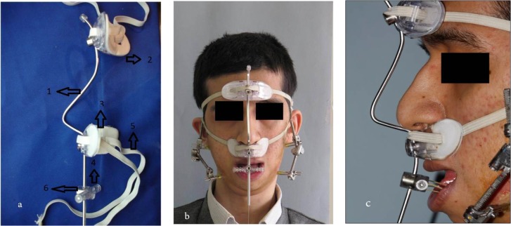 A New Method of Treatment of Temporomandibular Joint Ankylosis with Osteodistraction Using the Sh-Device: A Case Report.