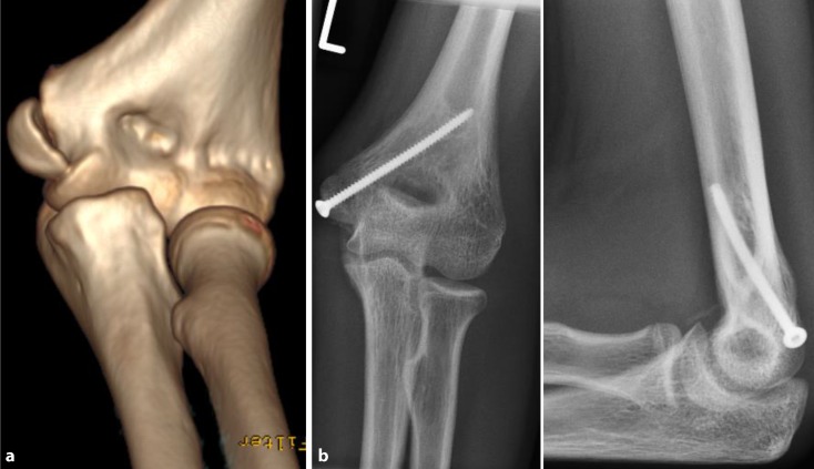 Fracture-pattern-related therapy concepts in distal humeral fractures.