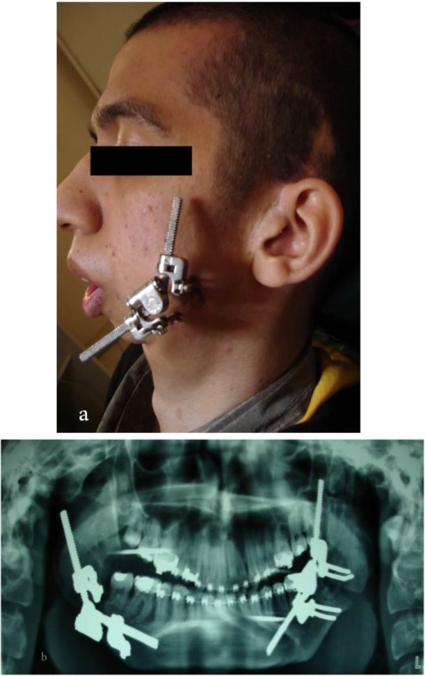 A New Method of Treatment of Temporomandibular Joint Ankylosis with Osteodistraction Using the Sh-Device: A Case Report.