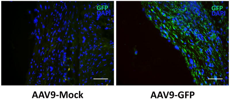 Introducing a Novel Method of Intravascular Adeno-associated Virus-mediated Gene Delivery.