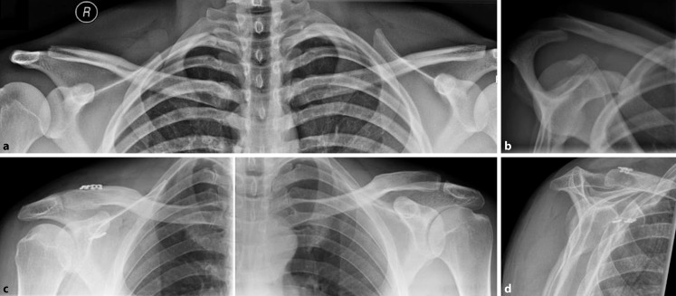 Nonoperative treatment of five common shoulder injuries: A critical analysis.
