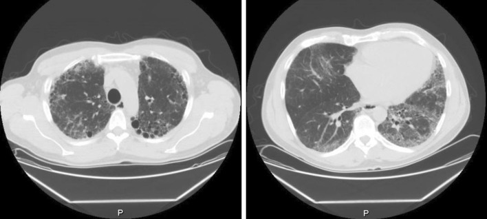 Desvenlafaxine-Induced Interstitial Pneumonitis: A Case Report.