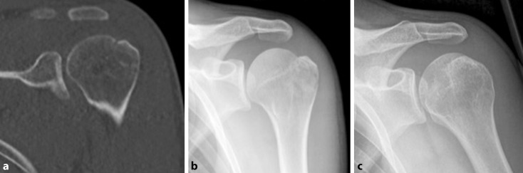 Isolated fractures of the greater tuberosity: When are they treated conservatively?: A baseline study.