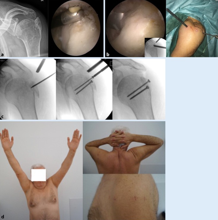 Isolated fractures of the greater tuberosity: When are they treated conservatively?: A baseline study.