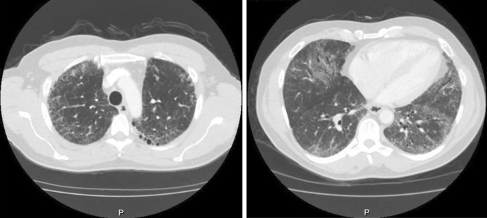 Desvenlafaxine-Induced Interstitial Pneumonitis: A Case Report.