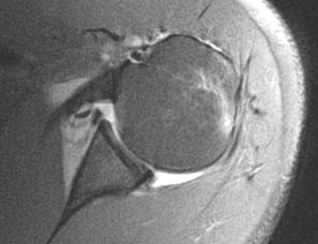 Nonoperative treatment of five common shoulder injuries: A critical analysis.