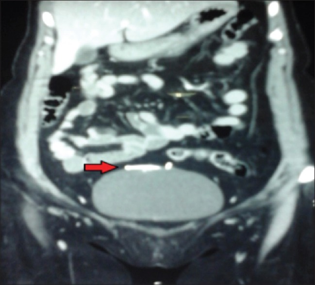 Combined Laparoscopic and Cystoscopic Retrieval of Forgotten Translocated Intrauterine Contraceptive Device.