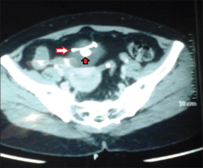 Combined Laparoscopic and Cystoscopic Retrieval of Forgotten Translocated Intrauterine Contraceptive Device.