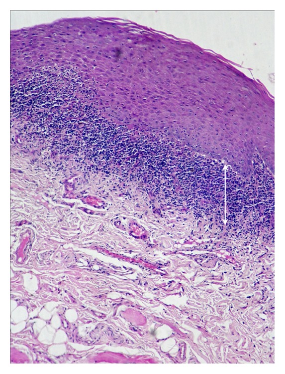 Role of Mast Cells in Oral Lichen Planus and Oral Lichenoid Reactions.