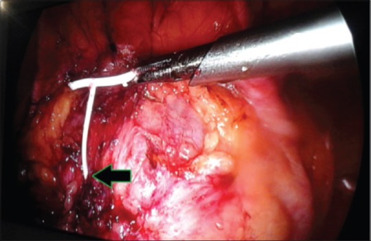 Combined Laparoscopic and Cystoscopic Retrieval of Forgotten Translocated Intrauterine Contraceptive Device.