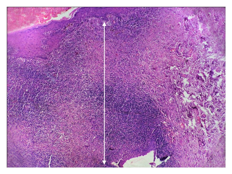 Role of Mast Cells in Oral Lichen Planus and Oral Lichenoid Reactions.