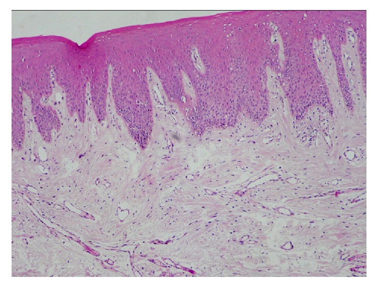 Role of Mast Cells in Oral Lichen Planus and Oral Lichenoid Reactions.