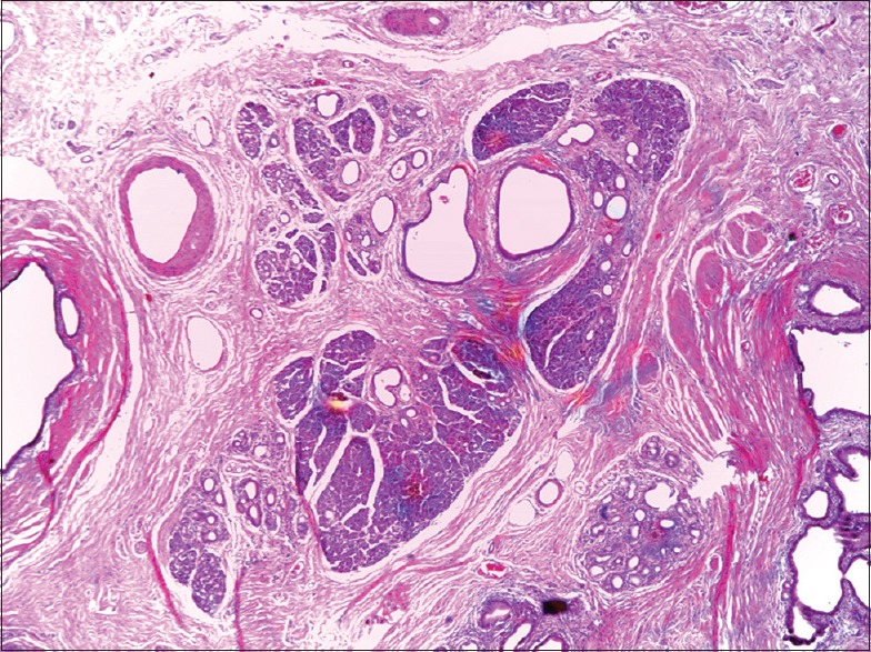 Ectopic Pancreas Causing Partial Gastric Outlet Obstruction: A Case Report and Review of Literature.
