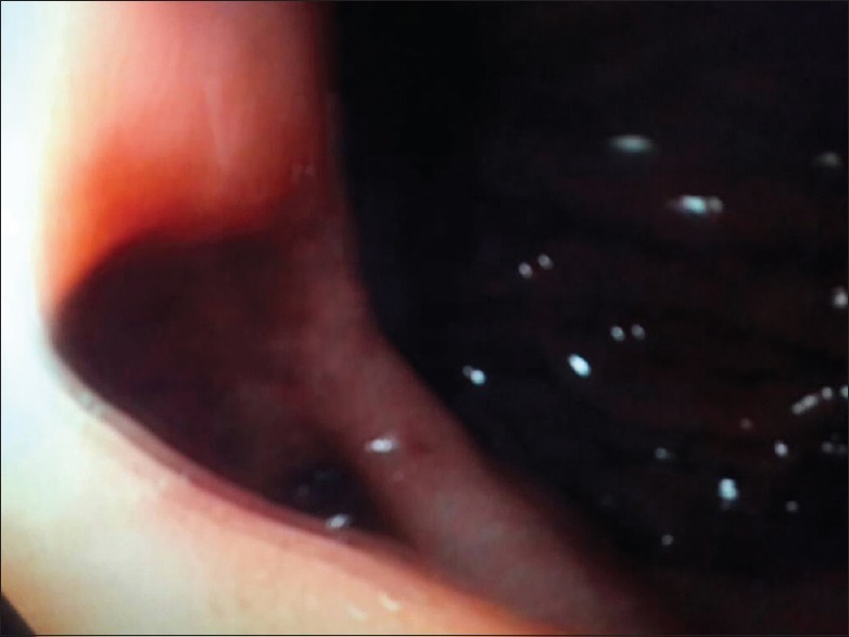 Ectopic Pancreas Causing Partial Gastric Outlet Obstruction: A Case Report and Review of Literature.