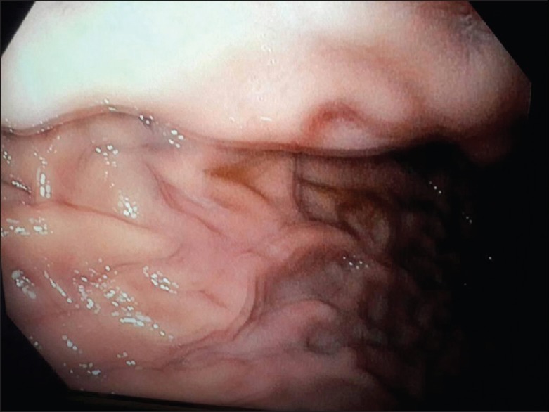 Ectopic Pancreas Causing Partial Gastric Outlet Obstruction: A Case Report and Review of Literature.