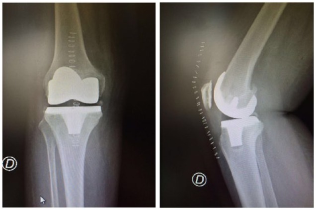 Medial Pivot in Total Knee Arthroplasty: Literature Review and Our First Experience.