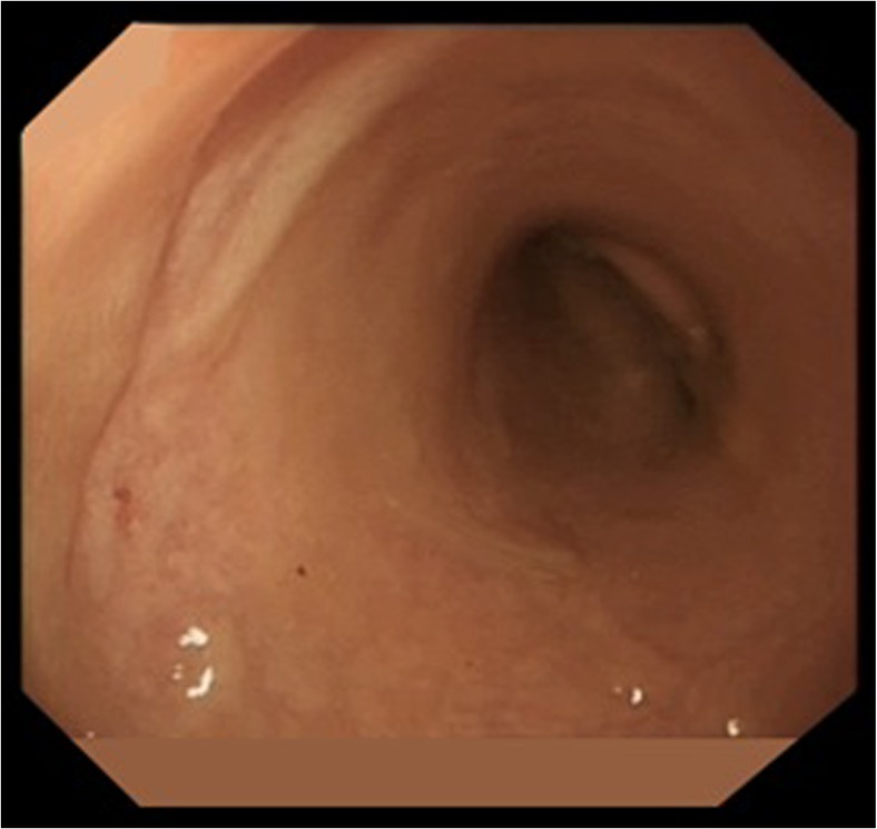 Watch-and-Wait as a Therapeutic Strategy in Rectal Cancer.