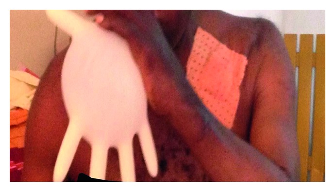 Complex Pulmonary Aspergilloma: Surgical Challenges in a Third World Setting.