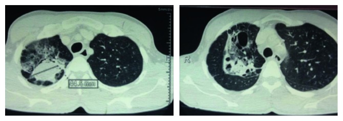 Complex Pulmonary Aspergilloma: Surgical Challenges in a Third World Setting.