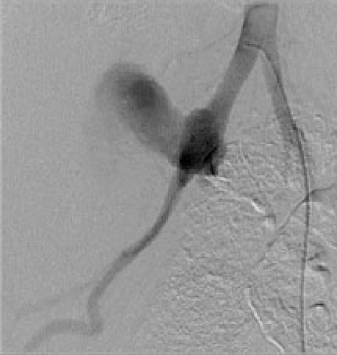 Delayed Hemorrhage in Kidney Transplantation: A Life-threatening Condition.