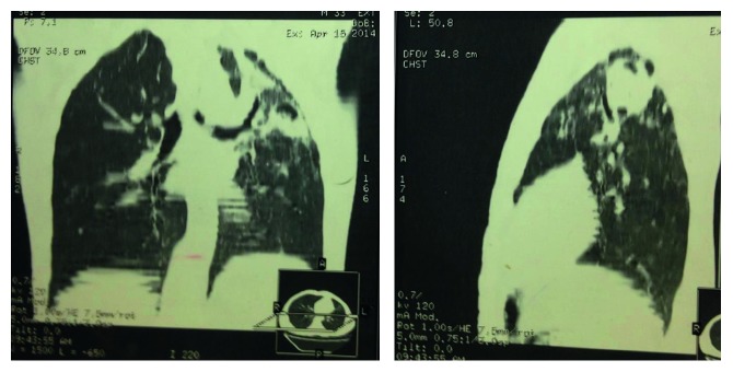 Complex Pulmonary Aspergilloma: Surgical Challenges in a Third World Setting.