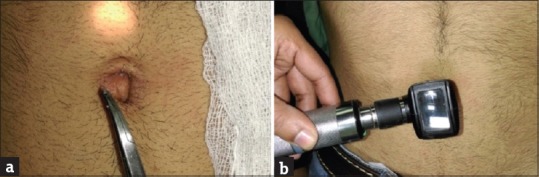 Use of Otoscope as a Diagnostic and Therapeutic Aid in Umbilical Pilonidal Sinus: A Novel Technique.