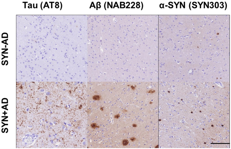 The Contribution of Tau, Amyloid-Beta and Alpha-Synuclein Pathology to Dementia in Lewy Body Disorders.