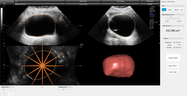 Comparison of 2D and 3D ultrasound methods to measure serial bladder volumes during filling: Steps toward development of non-invasive ultrasound urodynamics.