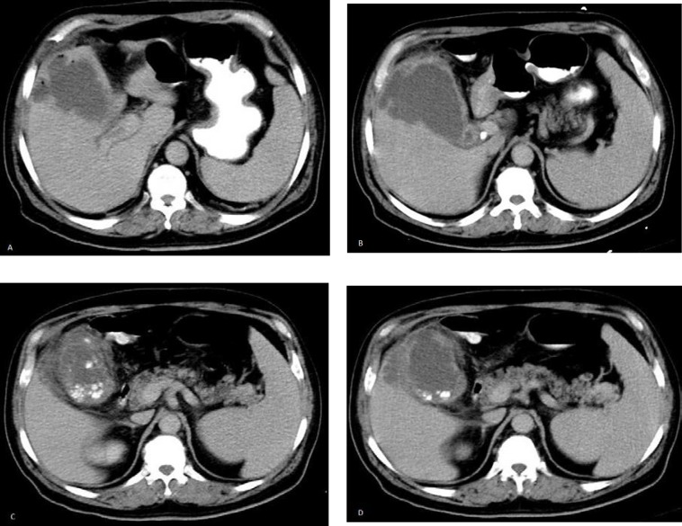 A 56-year-old Diabetic Man with Acute Epigastric Pain.