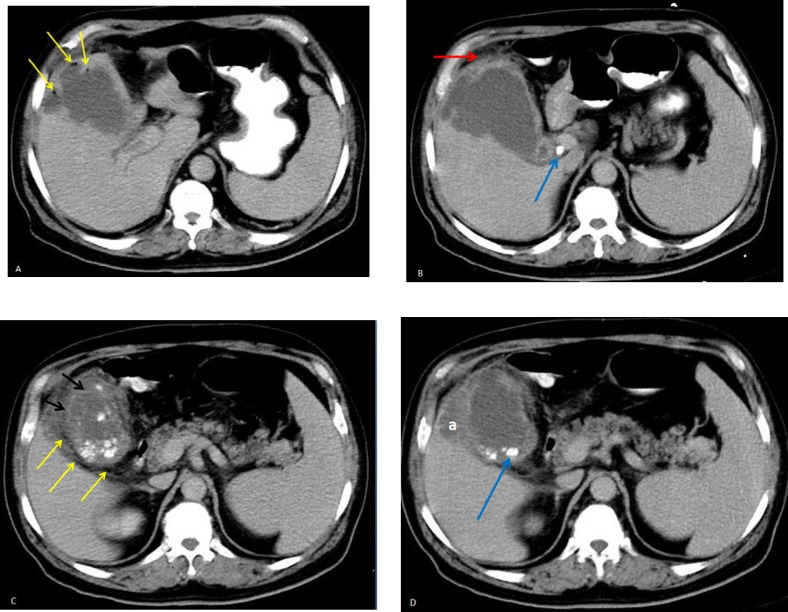 A 56-year-old Diabetic Man with Acute Epigastric Pain.