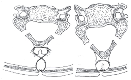 Modified Laminoplasty for Degenerative Cervical Spondylosis: The Technique of Floating Laminoplasty.