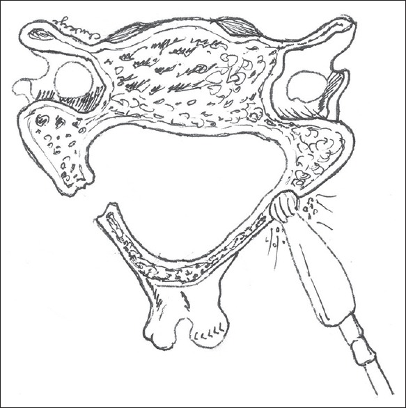 Modified Laminoplasty for Degenerative Cervical Spondylosis: The Technique of Floating Laminoplasty.