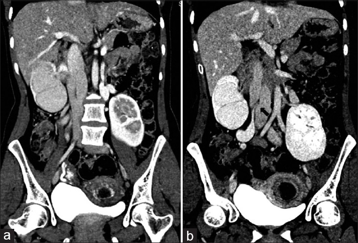Periureteral inferior vena caval venous ring presenting as urinary obstruction.