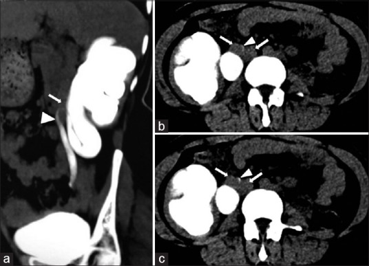 Periureteral inferior vena caval venous ring presenting as urinary obstruction.