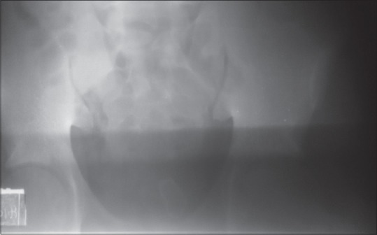 Unusual Intravesical Foreign Body Following Perineo-vesical Injury.