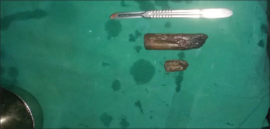 Unusual Intravesical Foreign Body Following Perineo-vesical Injury.