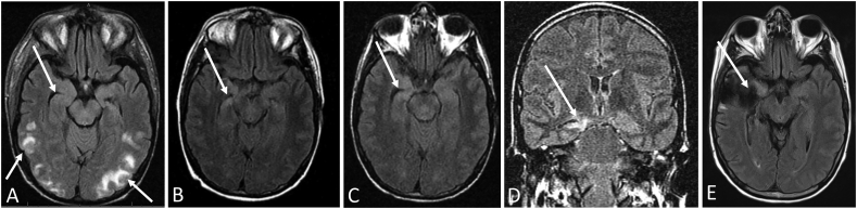 Drug-resistant epilepsy development following stem cell transplant and cyclosporine neurotoxicity induced seizures: Case report in an adult and analysis of reported cases in the literature