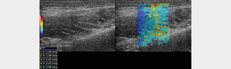 Reference Values for Shear Wave Elastography of Neck and Shoulder Muscles in Healthy Individuals.