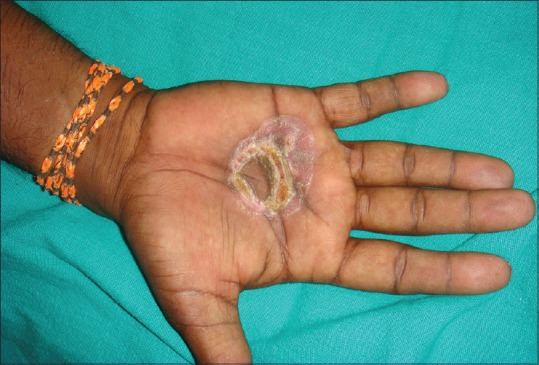 Camphor Burns on the Palm: An Unusual New Presentation.