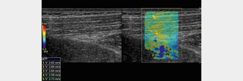 Reference Values for Shear Wave Elastography of Neck and Shoulder Muscles in Healthy Individuals.