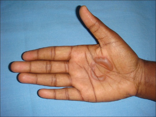 Camphor Burns on the Palm: An Unusual New Presentation.