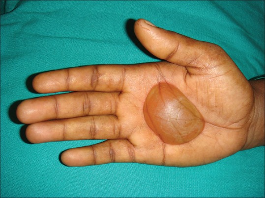 Camphor Burns on the Palm: An Unusual New Presentation.