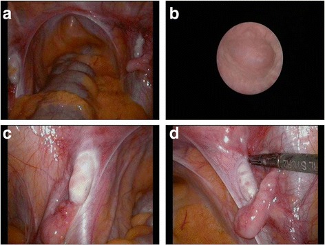 A novel, homozygous mutation in <i>desert hedgehog</i> (<i>DHH</i>) in a 46, XY patient with dysgenetic testes presenting with primary amenorrhoea: a case report.